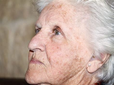 Old Age Spots On Skin