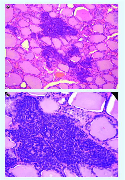 Photomicrograph Showing C Cell Hyperplasia In A Patient A Solid