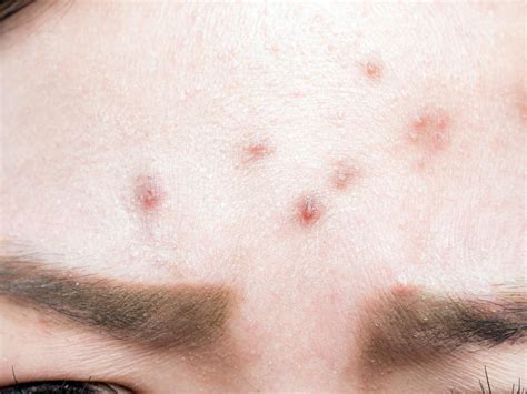 Bump On Forehead 7 Causes And Treatment