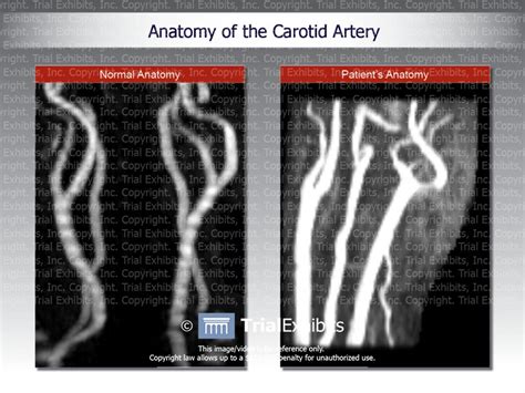 Carotid Artery Dissection Trialexhibits Inc Free Hot Nude Porn Pic