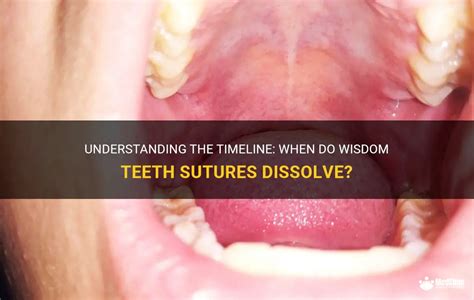 Understanding The Timeline When Do Wisdom Teeth Sutures Dissolve