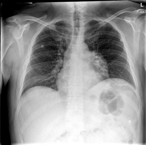 Lung Mass Chest X Ray