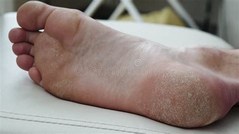 Dry Skin Psoriasis Of The Foot The Skin Is Damaged Dermatitis Eczema