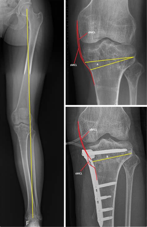 Medial Collateral Ligament Laxity In Valgus Knee Deformity Before And