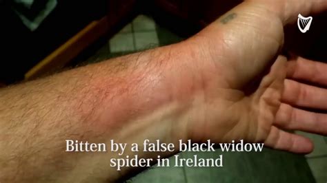 Black Widow Spider Bite Necrotizing Fasciitis And Spider Bites
