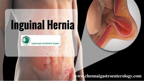 Inguinal Hernia Repair In Chennai Laparoscopic Hernia Surgery In In
