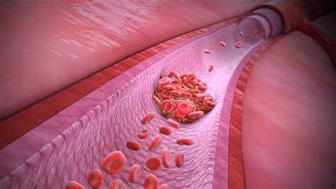 Revising What Makes Covid 19 Special Its Not Blood Clots By Shin