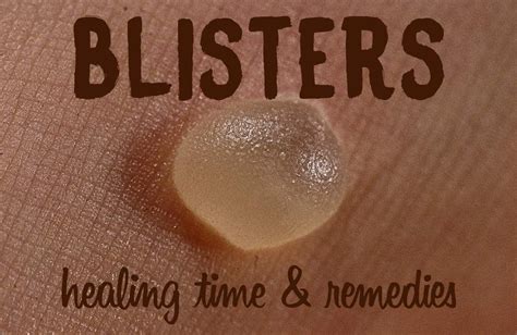 Blister Healing Time How Long Does It Take For A Blister To Heal