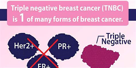 There Are Associations Between Obesity And Triple Negative Breast Cancer