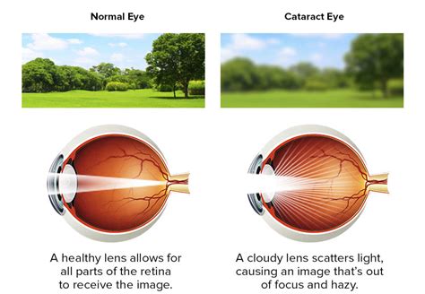 The Disease Of Eye Cataracts