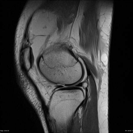 Osteochondral Fracture Lateral Femoral Condyle Radiology Case Radiopaedia Org