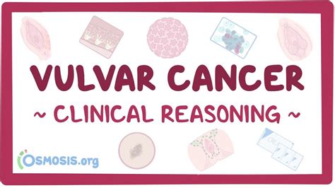 Vulvar Cancer Clinical Video Anatomy And Definition Osmosis
