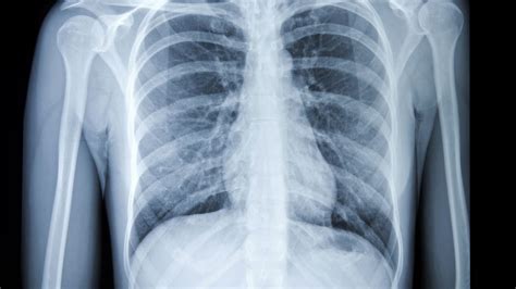 Chest X Ray Normal Results Chest X Ray Findings Monitoring Covid 19