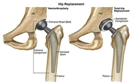 Physical Therapists Guide To Total Hip Replacement Arthroplasty