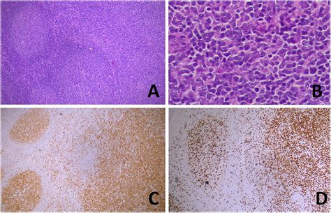Transformation Of Follicular Lymphoma Fl In A Diffuse Large B Cell