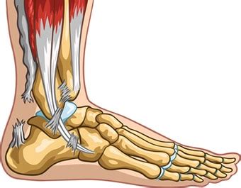 Read about symptoms, treatment, and recovery from a ruptured achilles with conservative treatment, serial casting occurs. Achilles Tendon Rupture Injury: Recovery Time, Surgery ...