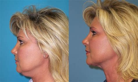 Facelifts Without Surgery Using Face Yoga Exercises Double Chin