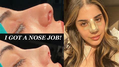 I GOT A NOSE JOB IN TURKEY WITH THE BEST SURGEON PART CLINICHUB YouTube