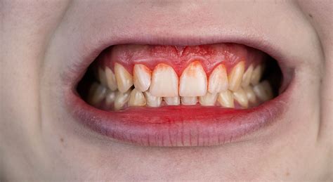 6 Dangers Of Untreated Gum Disease In Bothell Wa Crisafulli Dental