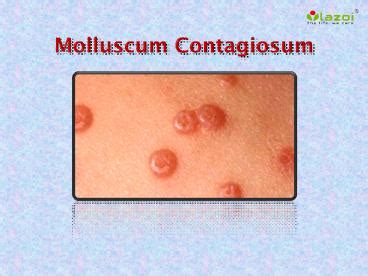 PPT Molluscum Contagiosum Symptoms Causes Diagnosis Treatment And