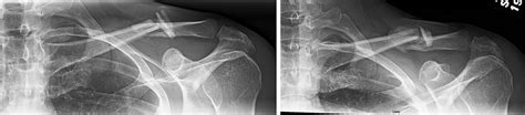 Clavicle Fracture Broken Collarbone Orthopaedic Trauma Association