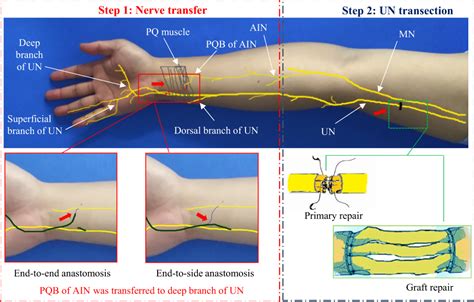 Repair Method For Complete High Ulnar Nerve Injury Based On Nerve Magn