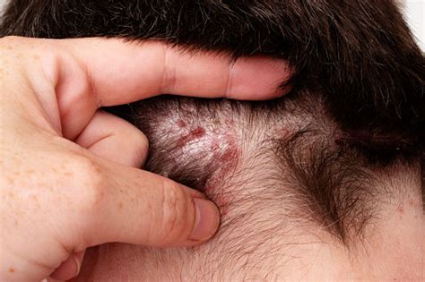 Detail Of Psoriatic Skin Disease In Hair Psoriasis Vulgaris With Narrow