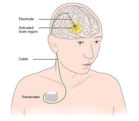 Parkinsons Disease Deep Brain Stimulation