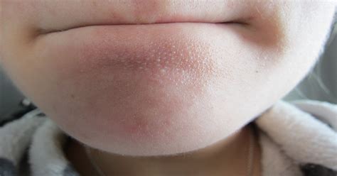What Are These White Spots On My Chin Skincareaddiction Images And