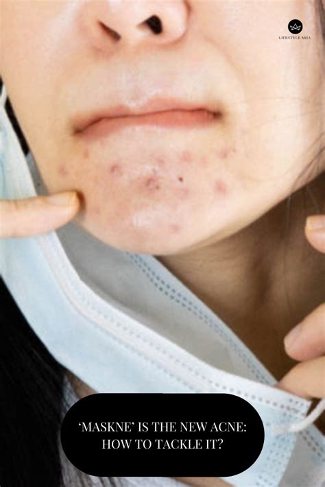 Face Masque Acne Face Mask Skin Tips Skin Care Tips Face Breaking