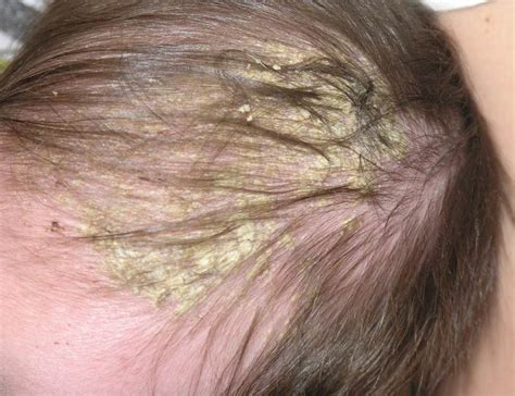Scalp Dermatitis Pictures Symptoms And Pictures