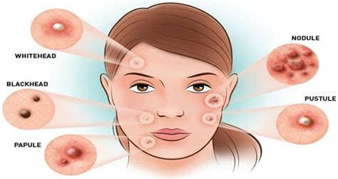 Hormonal Acne Natural Treatment Along With Causes Symptoms And Diet Plan