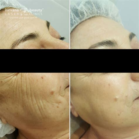 Non Surgical Face Lift Before And Afters Nirvana Beauty Laser Clinics