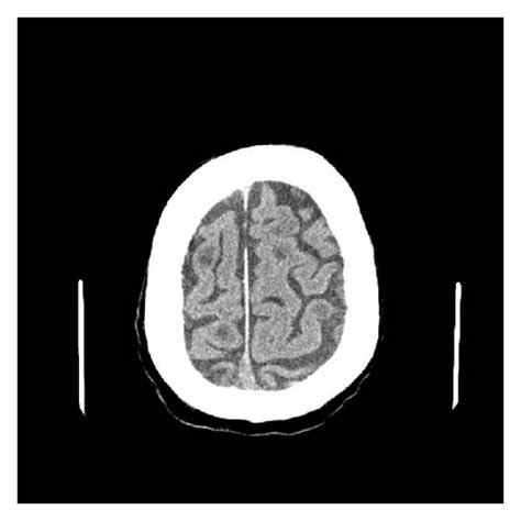 A Computerized Tomography Ct Scan Of The Patients Brain Showing