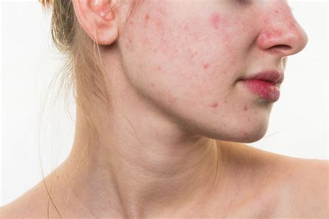 How To Remove Acne Scars And Holes Caused By Pimples