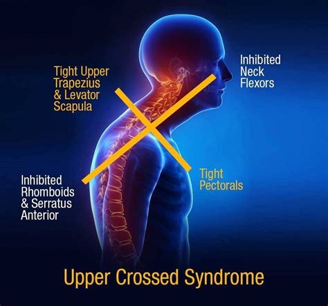 Upper Cross Syndrome And Its Clinical Presentation