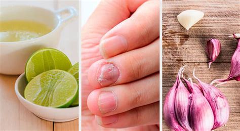 4 Home Remedies For Fungal Nail Infection Treatment Best Herbal Health
