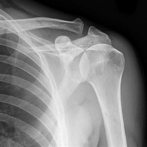 Shoulder Dislocation X Ray New Health Advisor
