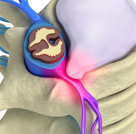 Herniated Disc Spine Back And Neck Pain Information