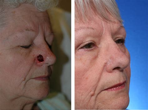 Repairing The Nose After Skin Cancer In Just One Step