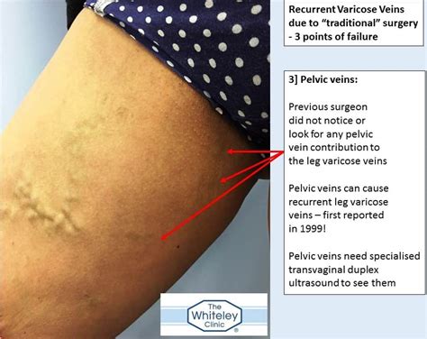 Recurrent Varicose Veins Due To Traditional Surgery The Whiteley Clinic