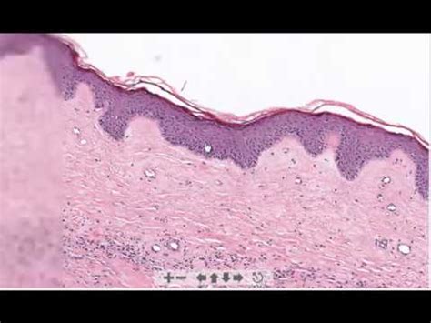 Una malattia autoimmune può incidere su uno o più tipi di organo o tessuto. Lichen sclerosus et atrophicus | Doovi