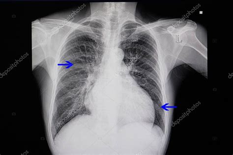 radiografía de tórax de un paciente con insuficiencia cardiaca que