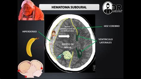 Hematomas Intracraneales Epidural Y Subdural Como Describir Una