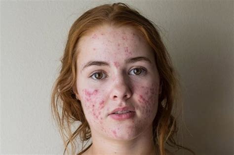 Student With Extreme Acne Reveals Incredible Transformation As Dark Red