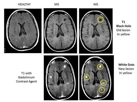 However, women are up to 3 times more likely to get it than men. Multiple Sclerosis Research: Education. The only thing ...