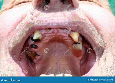Rotten Bad Teeth Caries Periodontal Disease Dental Stock Image