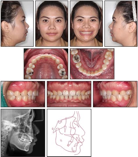 Case Report Jco Online Journal Of Clinical Orthodontics