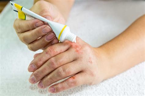 Causes And Treatment Of Eczema Everything You Need To Know