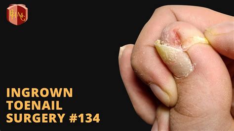 How It's Done: Ingrown Toenail Removal #134 ,#ingrowntoenailremoval, #